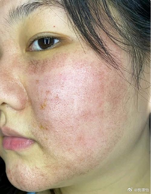 激光祛痘印后为何出现白点点？-图3