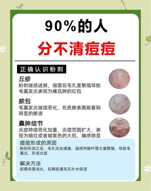 祛痘最好的方法到底是什么？-图2