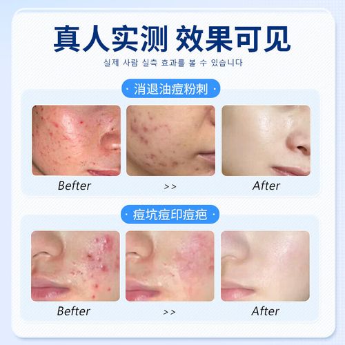 韩国祛痘药怎么买？-图1
