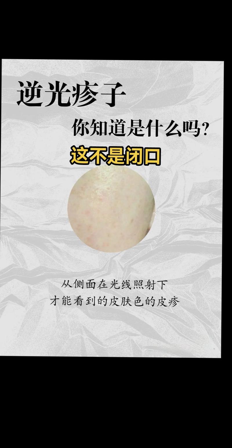 强脉冲光到底能不能祛闭口痘?-图1 强脉冲光到底能不能祛闭口痘?-图1