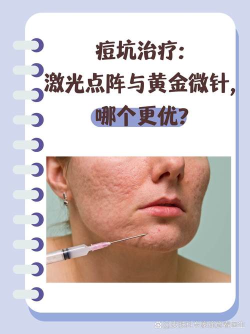 强脉冲光到底能不能祛闭口痘?-图2 强脉冲光到底能不能祛闭口痘?-图2