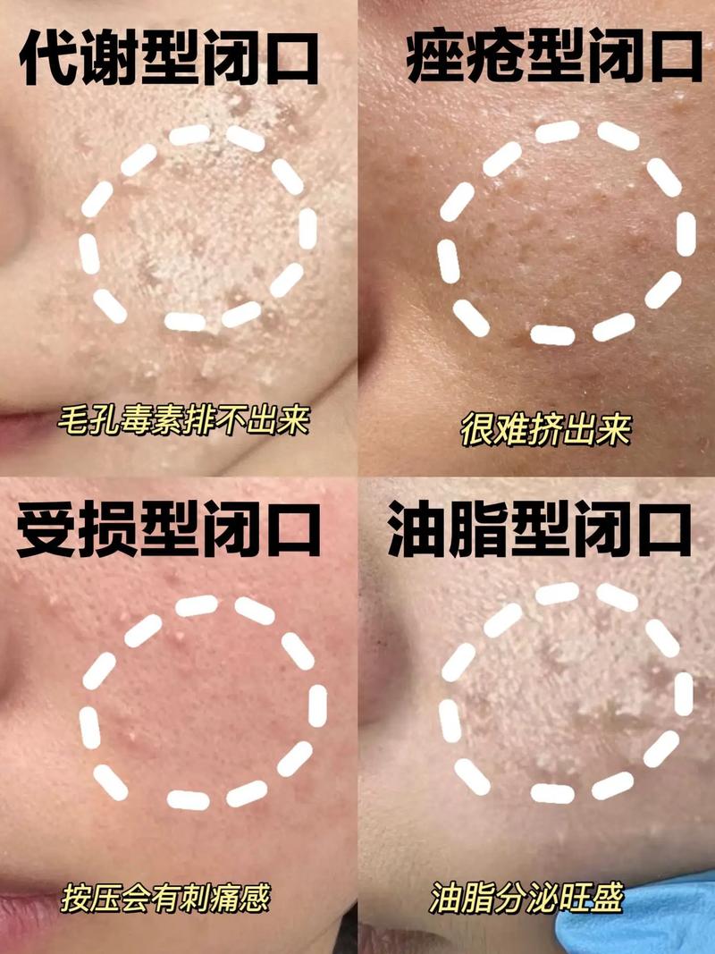 强脉冲光到底能不能祛闭口痘?-图3 强脉冲光到底能不能祛闭口痘?-图3