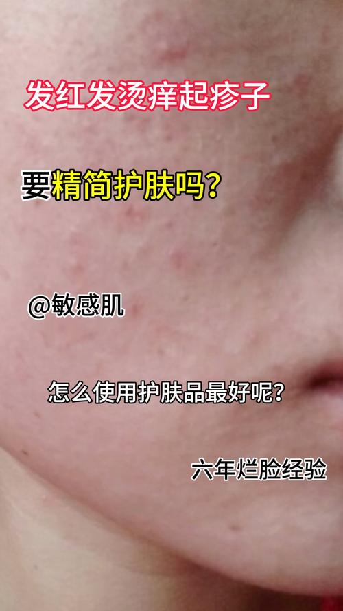 护肤品过敏多久能好？-图1