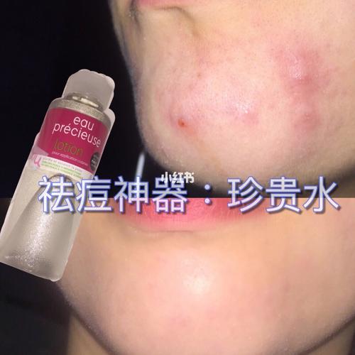 珍贵水祛痘效果真的好吗？-图1