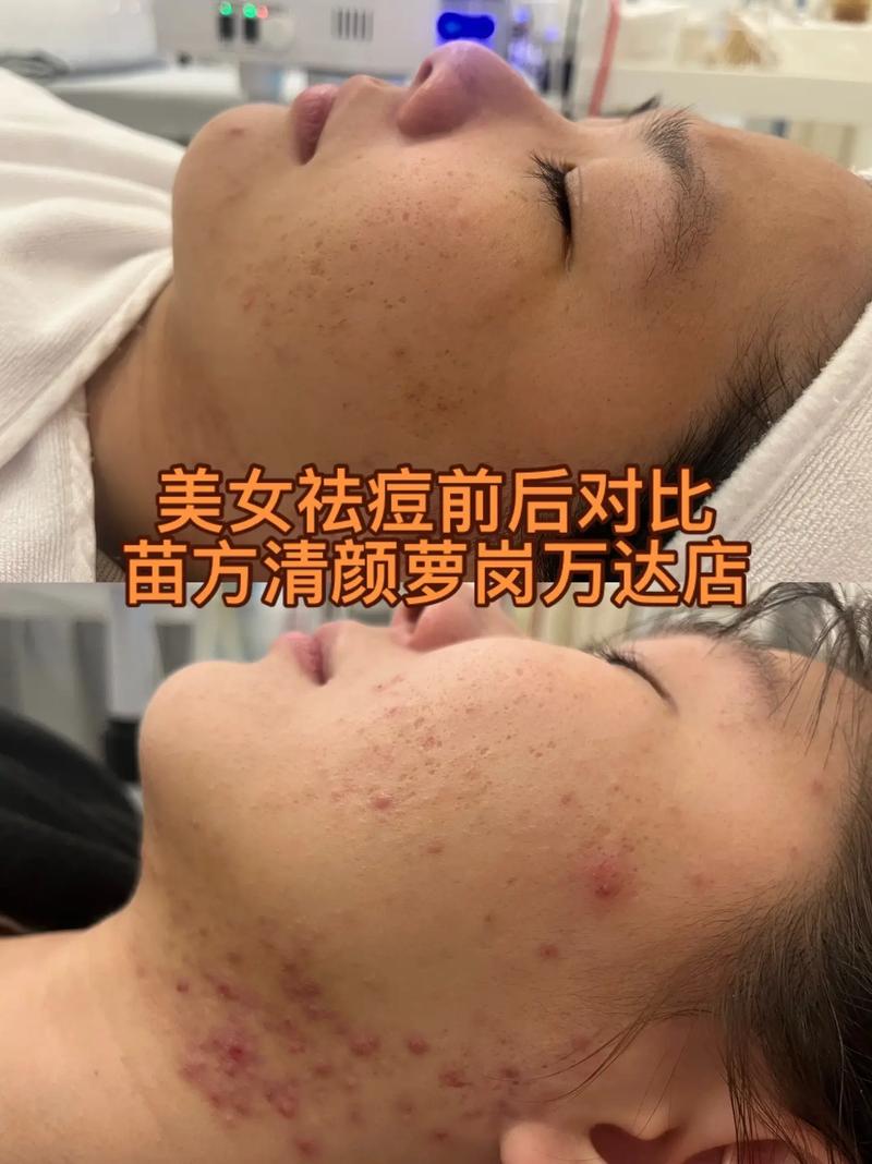 彩光和激光祛痘，哪种更适合你？-图2