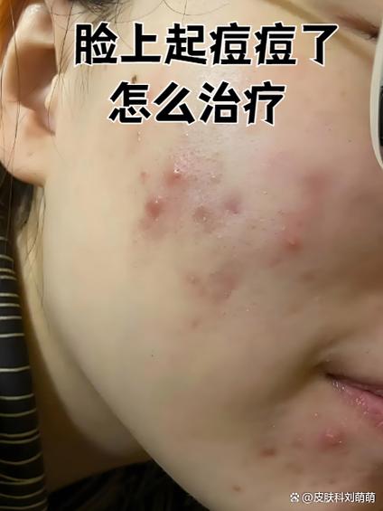 护肤营养过剩会长痘吗？-图1