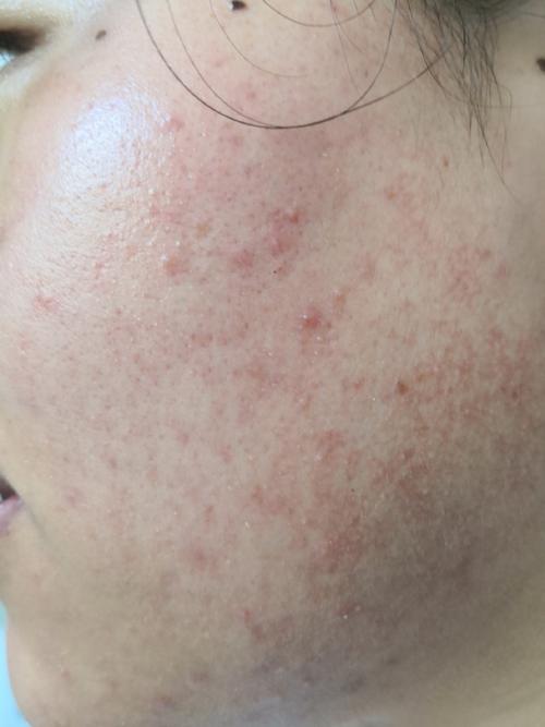 祛痘产品致痒疹怎么办？-图1