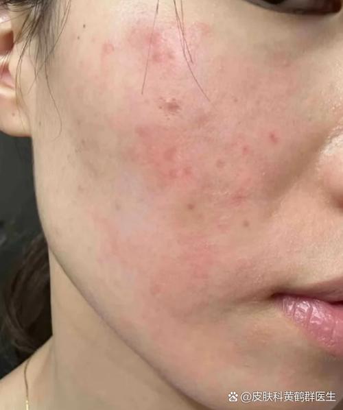 祛痘产品致痒疹怎么办？-图2