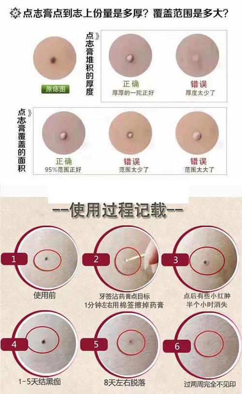 点痣后多久能恢复护肤？-图3