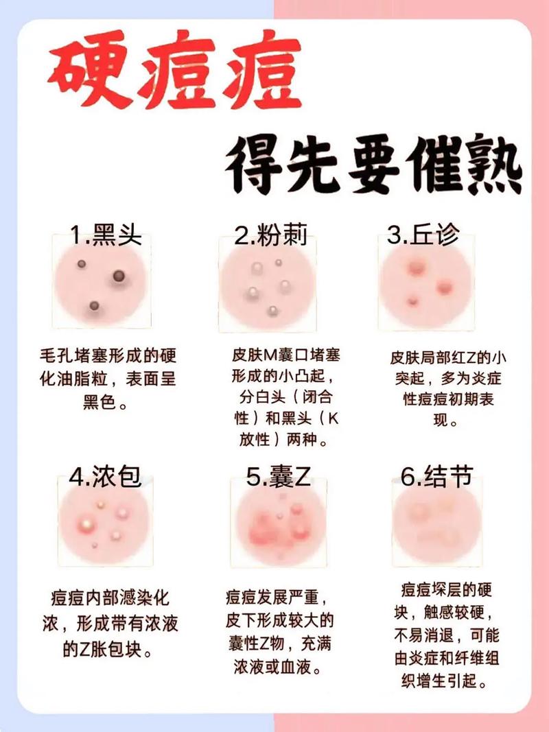 ddq祛痘效果究竟如何?-图1 ddq祛痘效果究竟如何?-图1