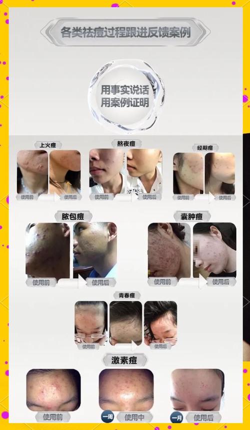ddq祛痘效果究竟如何?-图2 ddq祛痘效果究竟如何?-图2