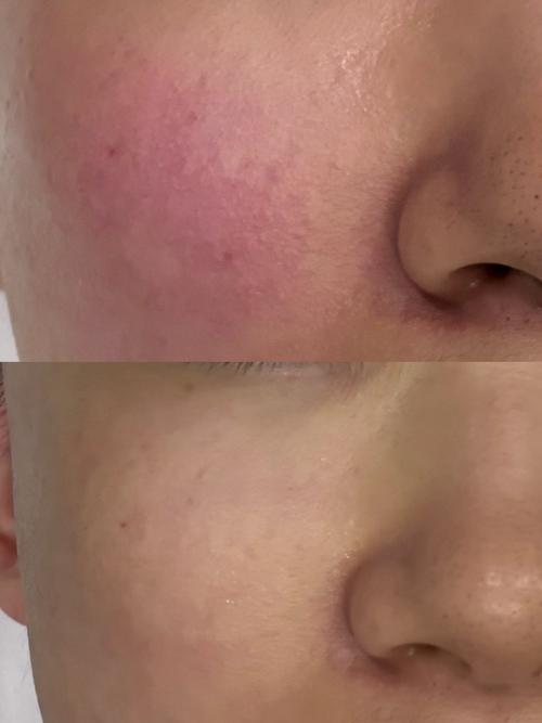 蓝光红光祛痘后皮肤干怎么办？-图1