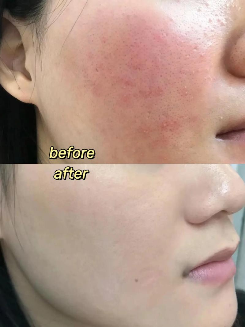 蓝光红光祛痘后皮肤干怎么办？-图2