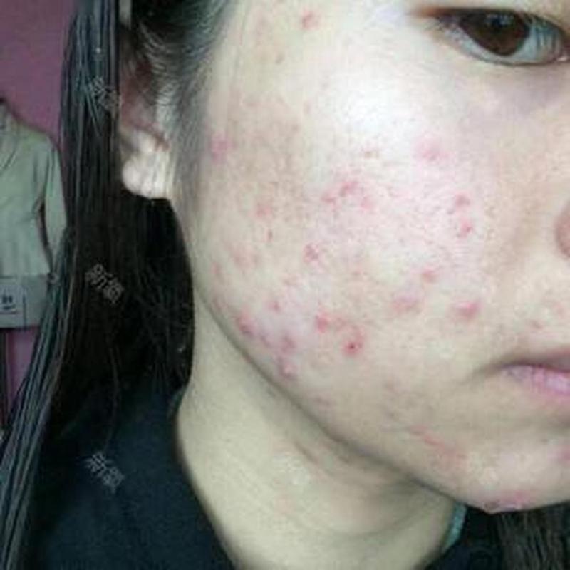 蓝光红光祛痘后皮肤干怎么办？-图3