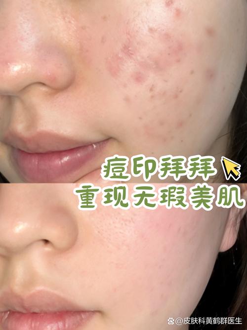 OPT冷光祛痘效果好吗？-图2