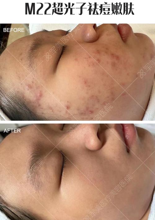 OPT冷光祛痘效果好吗？-图3