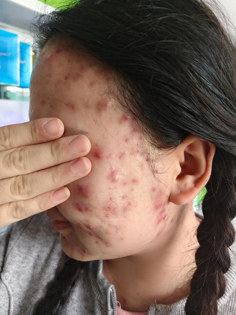 祛痘专家效果真的靠谱吗？-图3