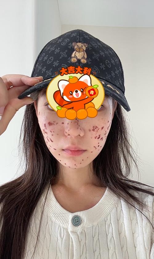 皮描祛痘去痘印真的有效吗？-图1