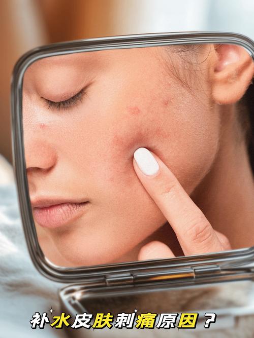 护肤品用后脸刺痛，为何会这样？-图1