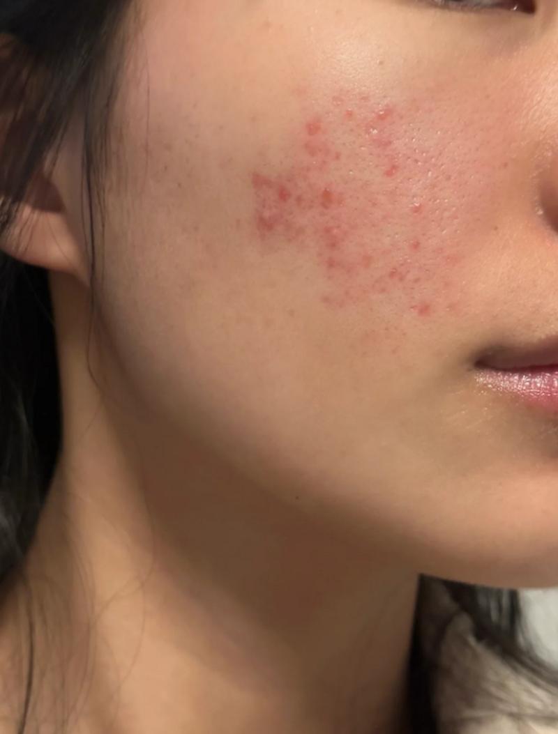 激光祛痘印效果真的好吗？-图1