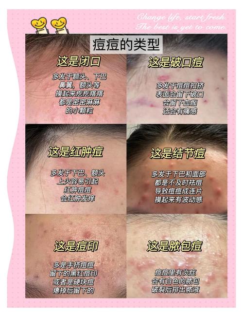 AHC祛痘效果到底怎么样？-图1