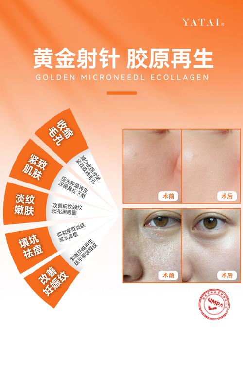 微针后多久能护肤？-图1