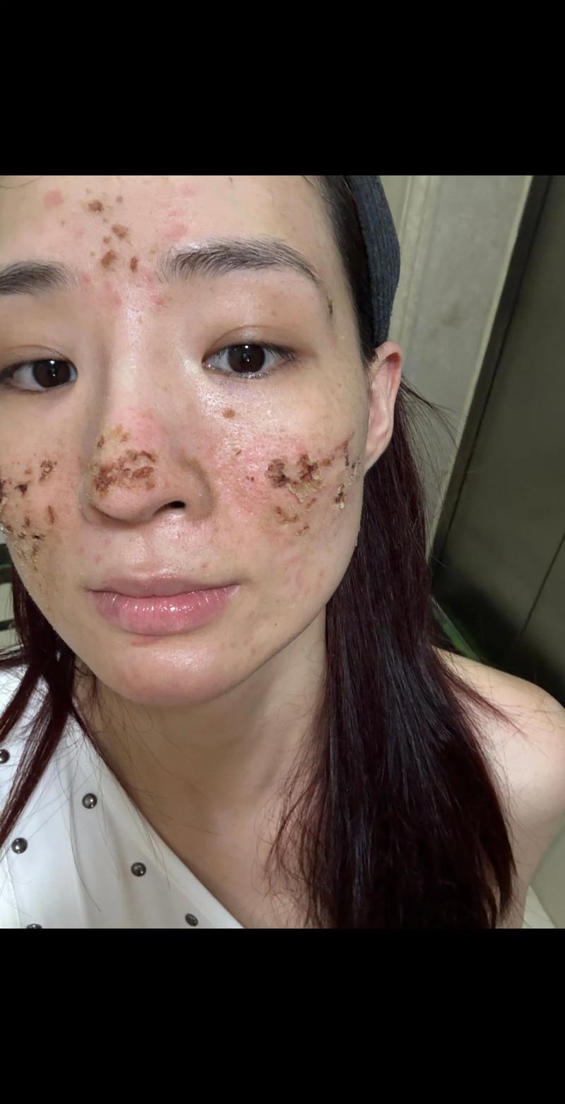 激光祛痘后多久结痂？-图1