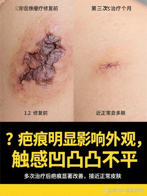 激光祛痘后多久结痂？-图2