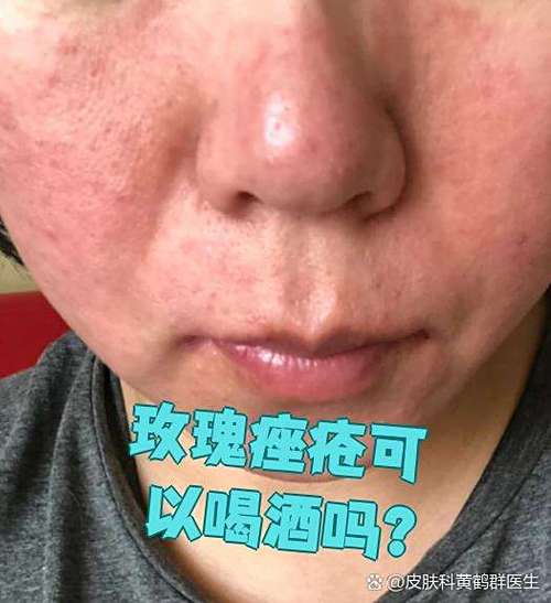 酒精擦脸祛痘真的安全有效吗？-图1