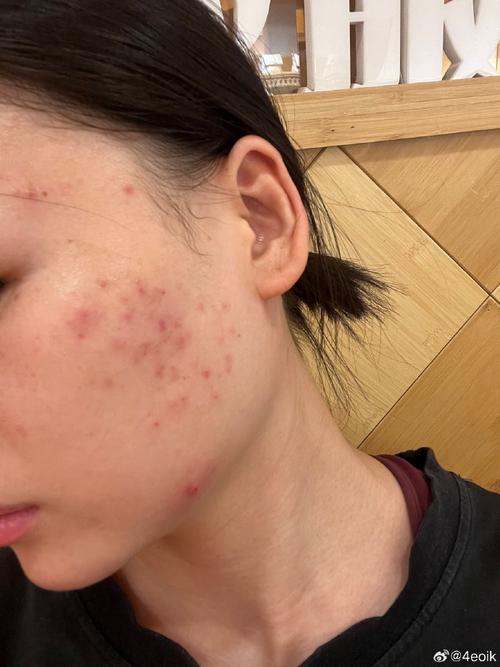 护肤品致痘？脸敏肌怎么选？-图1