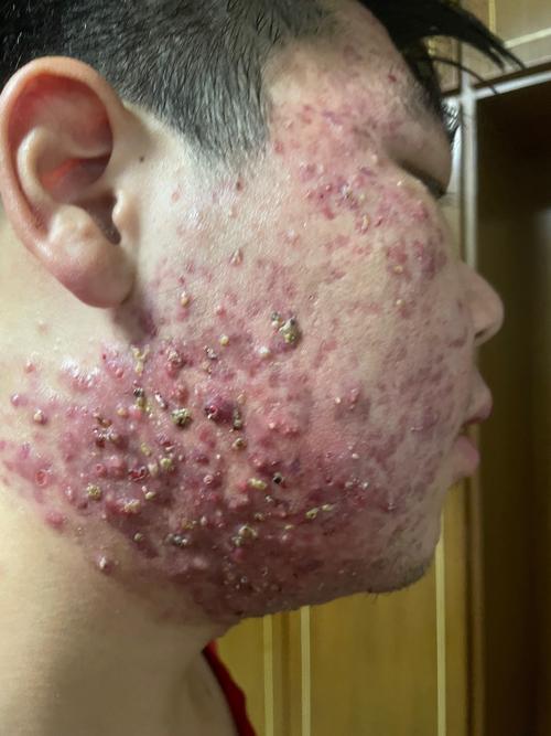 天津武警医院果酸祛痘效果怎么样？-图1