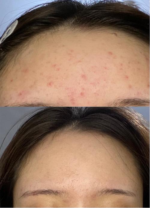 天津武警医院果酸祛痘效果怎么样？-图3