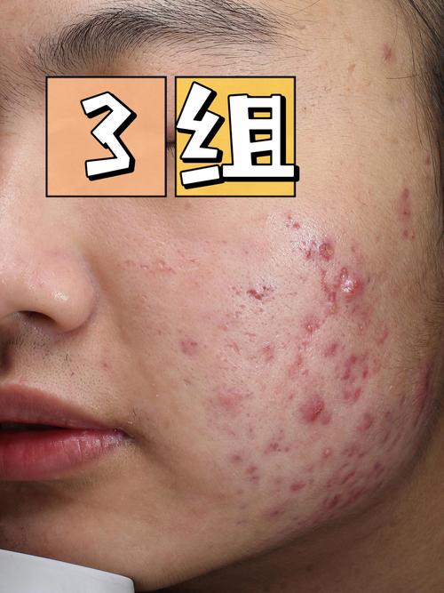 10%果酸真能祛痘坑吗？-图1