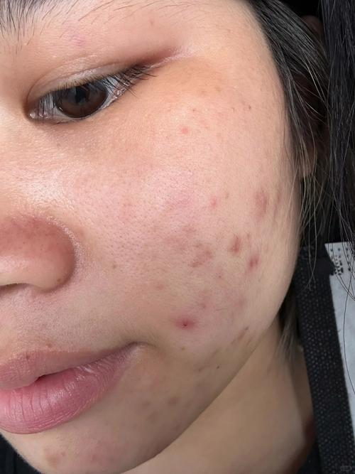 wis祛痘印凝胶过敏怎么办？-图2