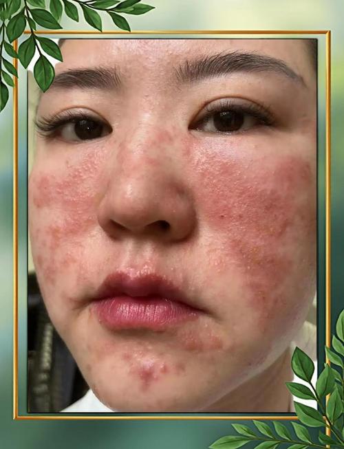 护肤品含激素会有什么危害？-图3