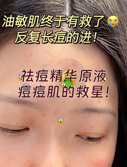 祛痘原液后必须用乳液吗？-图3