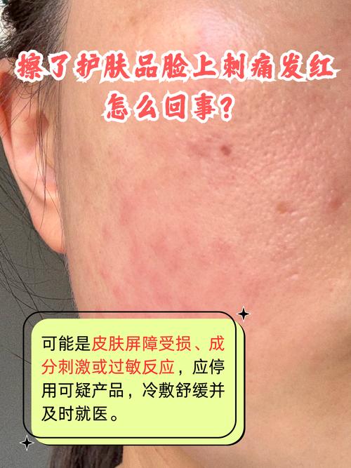 护肤品刺痛是过敏还是刺激？-图3