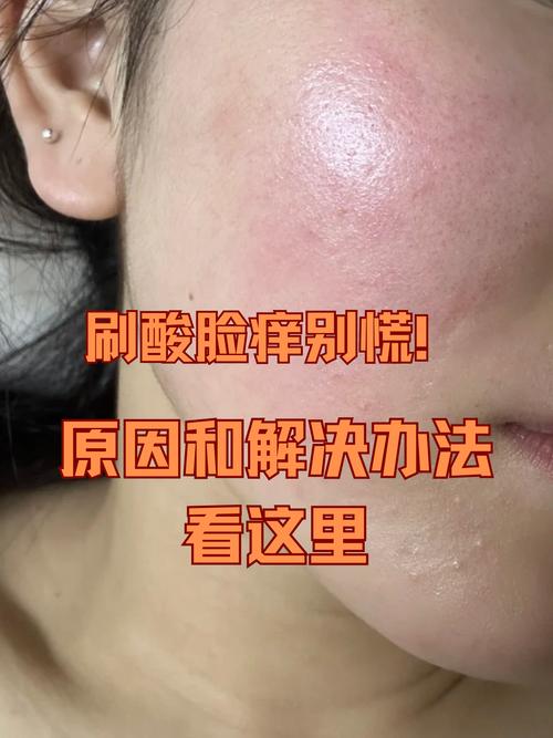 护肤品闷痘是咋回事？-图2