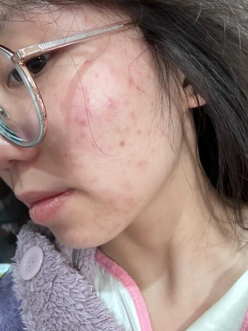 医院红蓝光祛痘后多久能沾水？-图2