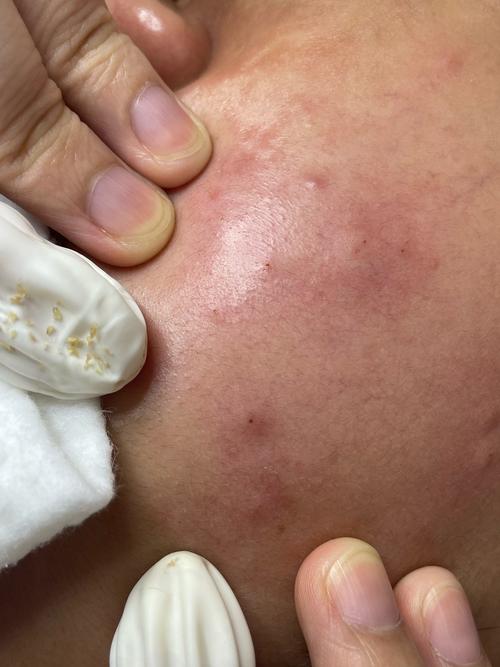 医院红蓝光祛痘后多久能沾水？-图3