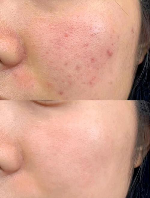 精油祛痘效果如何?-图1 精油祛痘效果如何?-图1