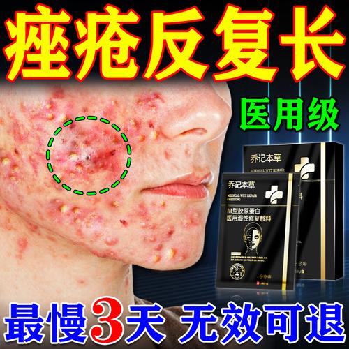 哪些消炎祛痘面膜品牌最值得选?-图2 哪些消炎祛痘面膜品牌最值得选?-图2