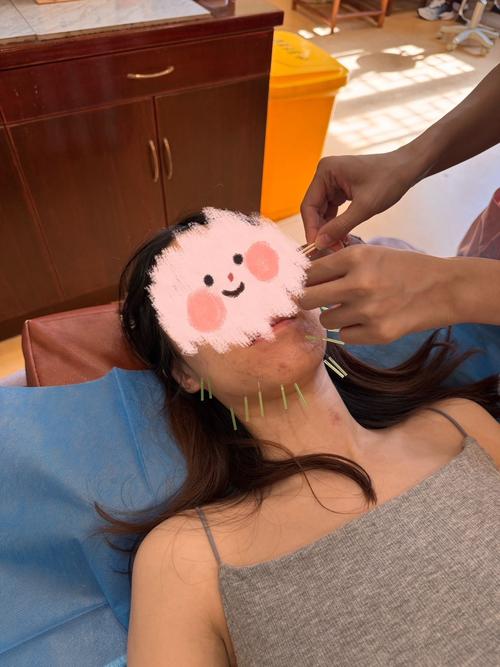 疏通经络祛痘效果到底怎么样？-图2