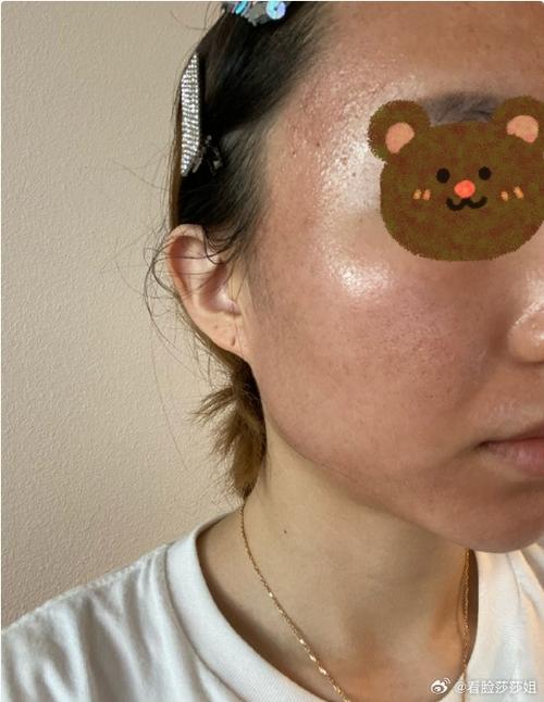 自体血清PRP祛痘印效果怎么样？-图1