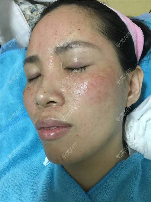 自体血清PRP祛痘印效果怎么样？-图3