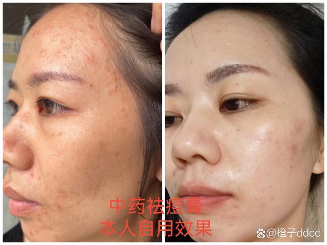 Dr.MJ祛痘粉末效果真的好吗?-图1 Dr.MJ祛痘粉末效果真的好吗?-图1