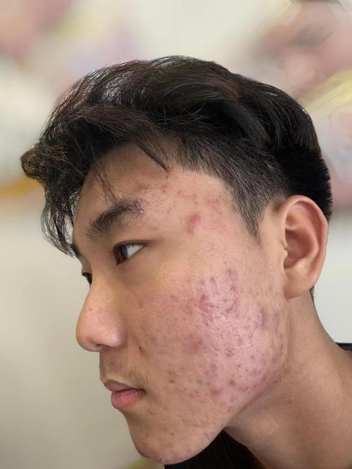 男士祛痘效果最好的方法是什么?-图1 男士祛痘效果最好的方法是什么?-图1