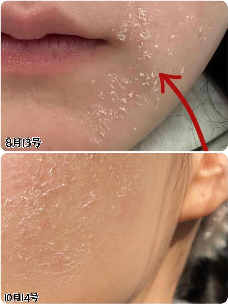 DHC祛痘精华蜕皮是正常反应吗？-图1