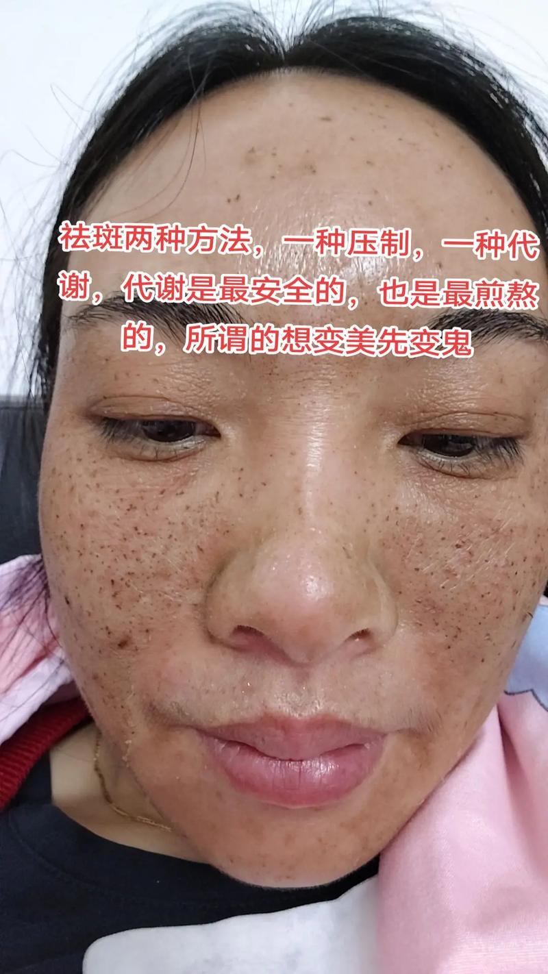 DHC祛痘精华蜕皮是正常反应吗？-图3