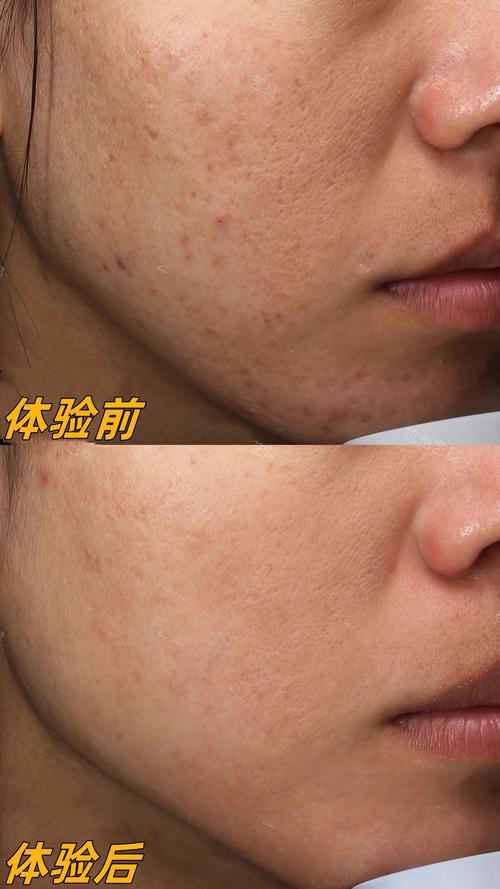激光祛痘印和光子嫩肤哪个更适合你？-图3